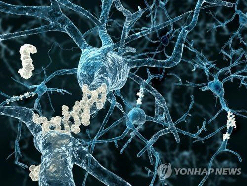 베타 아밀로이드 플라크가 형성된 치매 환자의 뇌신경[연합뉴스]